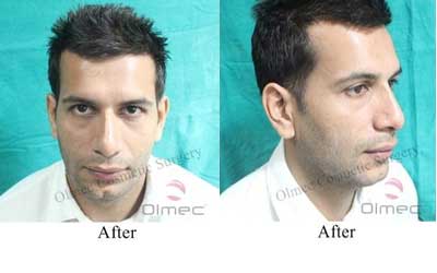 Olmec rhinoplasty result, after surgery