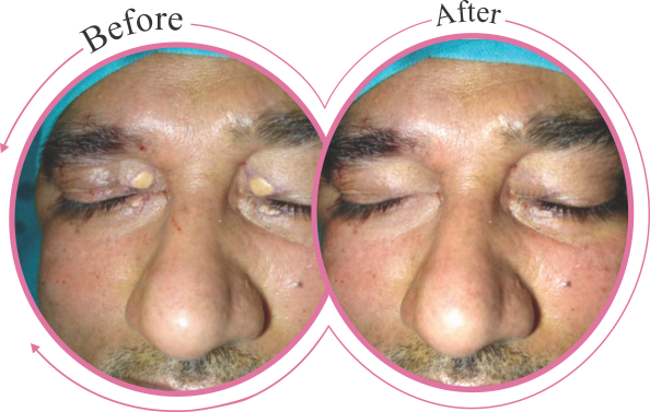 Xanthelasma Removal