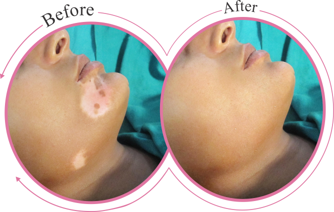 Xanthelasma Removal