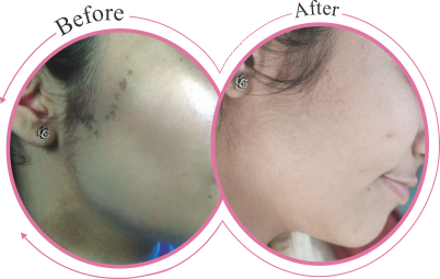 Xanthelasma Removal