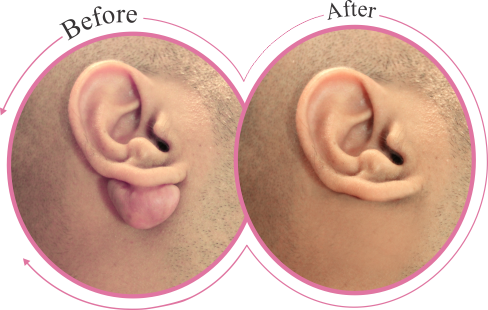 Xanthelasma Removal