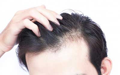 Hair Loss Treatment Delhi