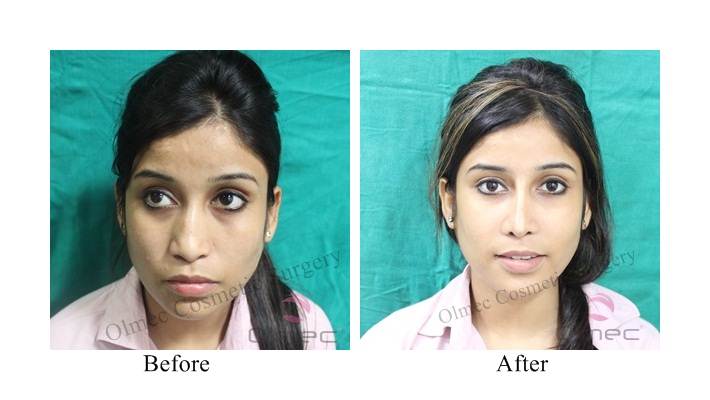 Rhinoplasty Surgery in Delhi Nose Job Nose Reshaping Cost